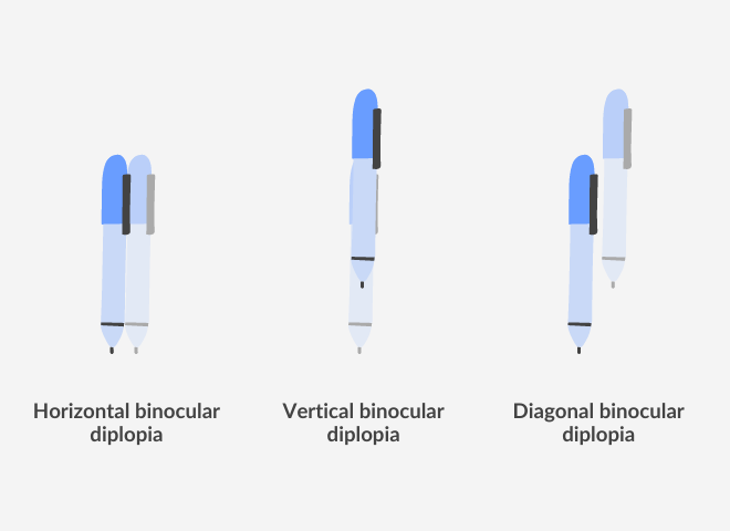 Double Vision Symptoms Causes And Treatments For Diplopia Vision Direct Au 7536